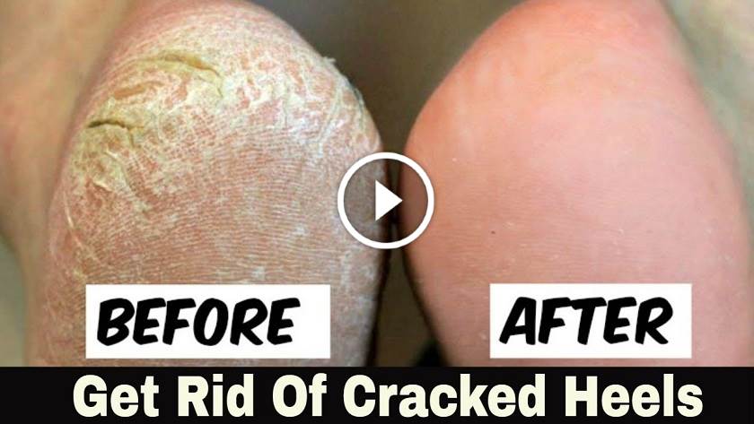get rid of cracked heels at home